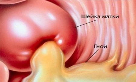 Наиболее частые симптомы венерических заболеваний у мужчин и женщин